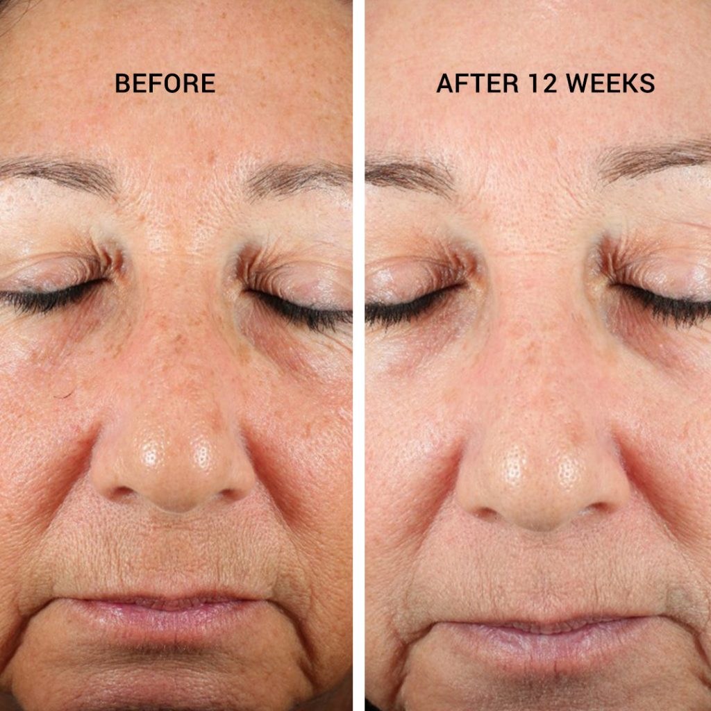 Advanced-Retinol-Serum-5X_Before_After_B