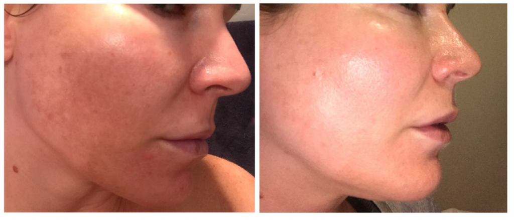 Brightening Pads Before & After