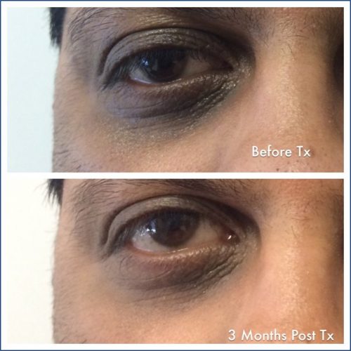 Enriched Eye Cream Before After
