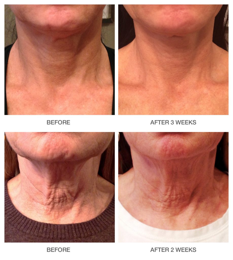 Lift-Tightening-Neck-and-Decolletage-Cream Before & After