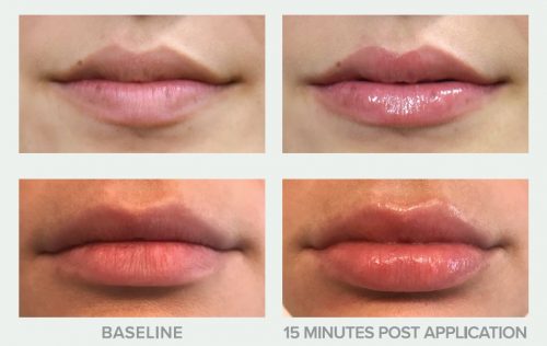 Plump-Perfect-Lip-Treatment_Before & After