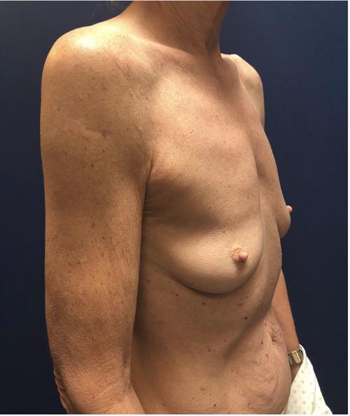 Breast Augmentation Before & After Photos Patient 74, Lafayette, CA