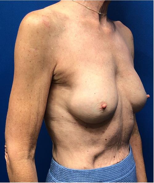 Breast Augmentation Before & After Photos Patient 74